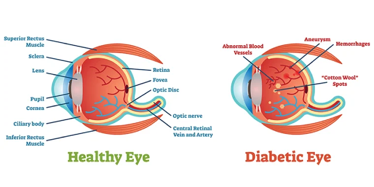 Read more about the article How Diabetes Affects Your Eyes