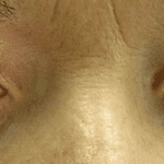 Glaucoma Symptoms: Early Detection Could Save Your Sight