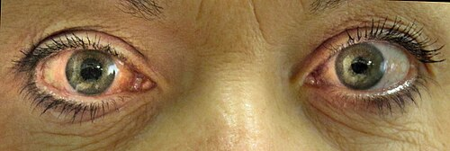 You are currently viewing Glaucoma Symptoms: Early Detection Could Save Your Sight