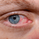 Watery Eyes: Common Causes and Effective Treatments