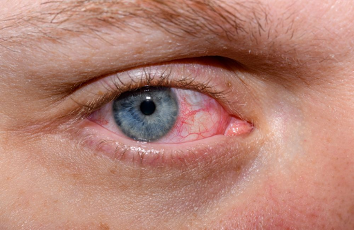 You are currently viewing Watery Eyes: Common Causes and Effective Treatments